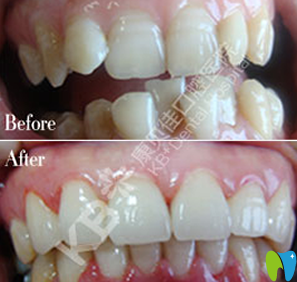 我在沈陽康貝佳口腔做的隱形牙齒矯正前后效果對比照片