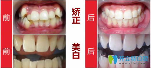 沈陽康貝佳隱形牙齒矯正及牙齒美白前后對比效果圖