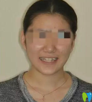 看本人在沈陽康貝佳口腔花19800元做的隱形牙齒矯正效果好嗎