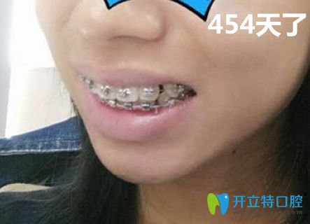 牙知道口腔做牙齒正畸第454天效果圖