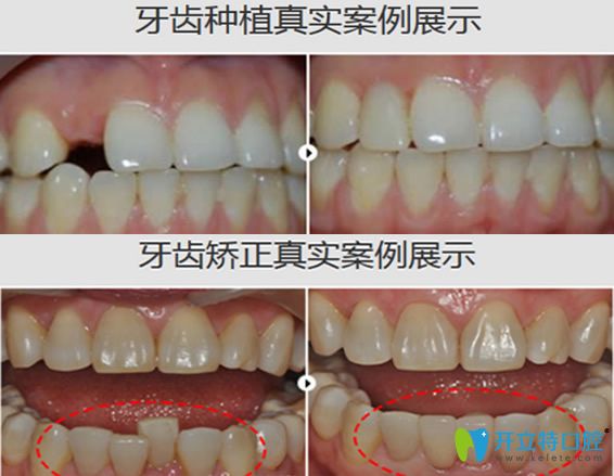 海濤口腔牙齒種植+牙齒矯正案例前后對比圖展示