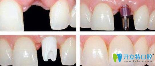 瑞安口腔趙俊仙醫(yī)生單顆牙種植案例