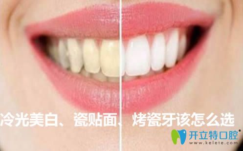 冷光美白和牙齒瓷貼面及烤瓷牙該怎么選?來(lái)看價(jià)格是多少錢(qián)