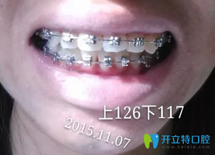 在淮安牙知道口腔戴牙套8個月左右牙齒變化照