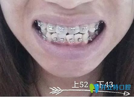 淮安牙知道口腔牙齒正畸后1個多月照