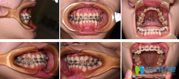 拜博口腔牙齒矯正18個(gè)月效果