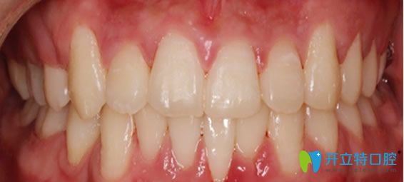 成都瑞安口腔牙齒矯正后效果圖