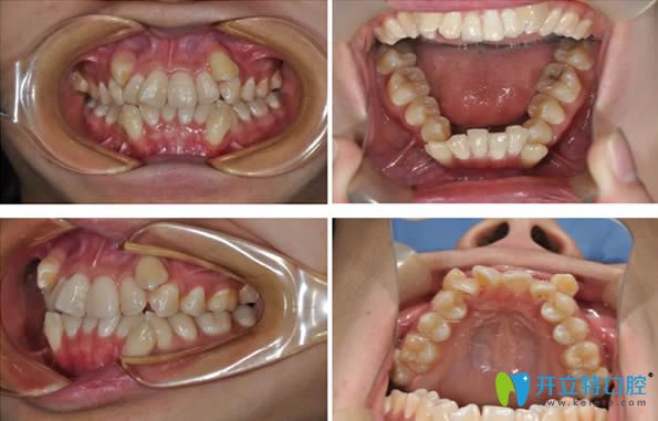 26歲的我，在鄭州拜博口腔花1萬多元做了自鎖托槽牙齒矯正