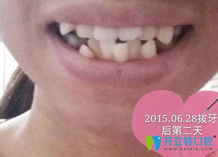 較后一次在淮安牙知道（三淮）拔牙后第二天