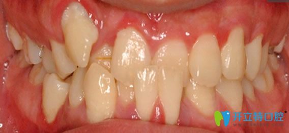 成都瑞安口腔劉思江醫(yī)生牙齒正畸前