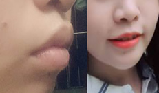 我骨性齙牙在東莞西妃口腔做矯正1年啦 我的臉型變化大嗎