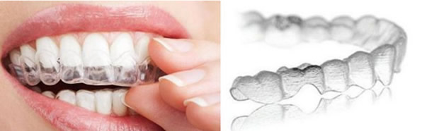 哪些人不適合戴隱形牙套 牙套的種類、價格及優(yōu)劣勢大比拼