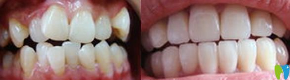 瑞安口腔牙齒矯正代表案例