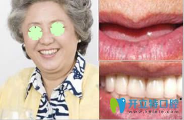 重慶皇仕種植牙效果對比照