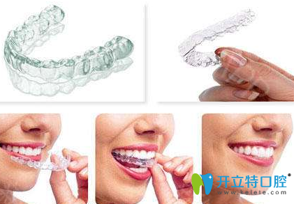 隱形牙套有哪些品牌？揭曉國(guó)產(chǎn)和進(jìn)口牙套種類(lèi)及價(jià)格表