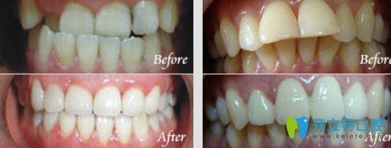 魯璇牙齒矯正真人案例前后效果對比圖