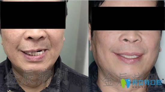 <!--<i data=20240703-sp></i>-->馬瀧齒科金辰allon4種植牙真實(shí)