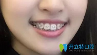 大眾口腔矯正牙齒兩年后效果 大眾口腔矯正牙齒兩年后效果