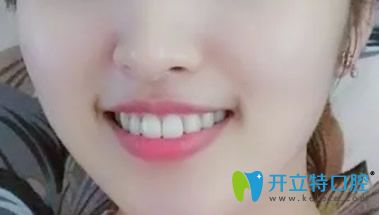 大眾口腔牙齒矯正三年后效果案例 大眾口腔牙齒矯正三年后效果案例
