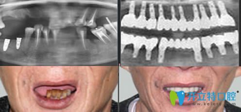 重慶皇仕口腔半口牙種植效果圖