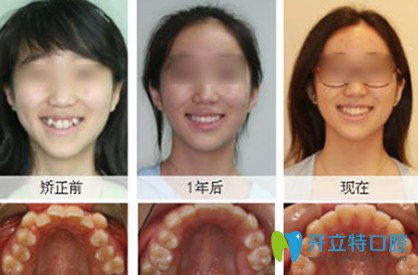 美奧口腔牙齒矯正前后效果對比圖