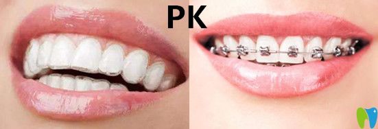 隱形矯正VS傳統(tǒng)牙套哪種效果？有什么區(qū)別呢？