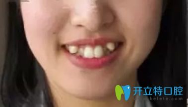 武漢愛尚大眾口腔牙齒矯正前 武漢愛尚大眾口腔牙齒矯正前