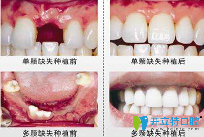 西安美奧口腔種植牙效果對比圖