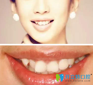 我很幸運(yùn)在西安美奧口腔做隱適美牙齒矯正還減了1萬元費(fèi)用