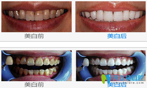 瑞泰口腔牙齒美白效果對比圖