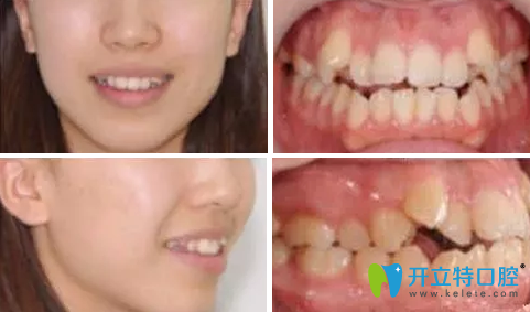 28歲在成都瑞泰口腔做隱形矯正牙，是我這輩子都不后悔的事