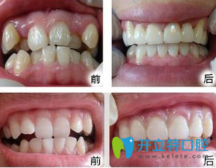 成都瑞泰口腔劉澤萍醫(yī)生牙齒矯正前后效果對(duì)比圖