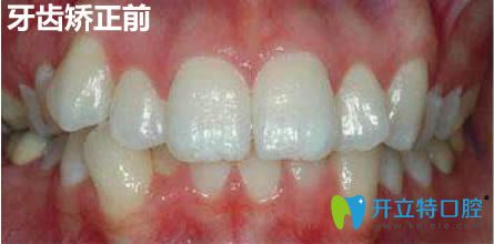 在上海馬瀧齒科做隱適美牙齒矯正12個(gè)月啦,來(lái)說下我的感受