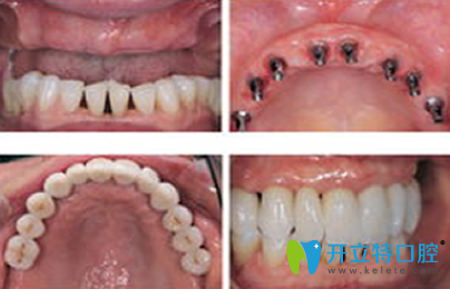 成都瑞泰口腔種植牙前后效果對比圖