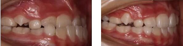 ?孩子牙齒反頜 在武漢健齒口腔用了MRC矯治器 看效果怎么樣