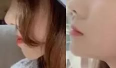 地包天矯正案例:杭州拜博口腔地包天矯正3個(gè)月側(cè)臉變化很大