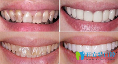 鄭州精益口腔牙齒美白前后效果對(duì)比圖