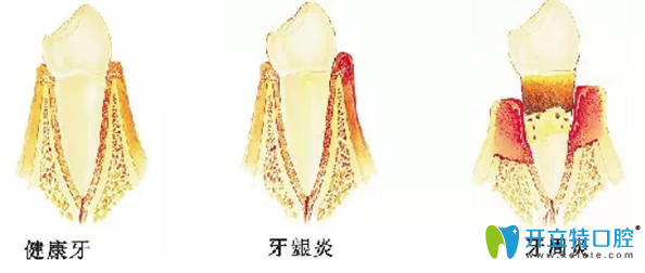 牙周炎和牙齦炎的牙齒特征