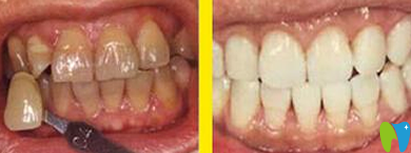 四環(huán)素牙如何變白？看牙齒變白簡單有效的偏方大全