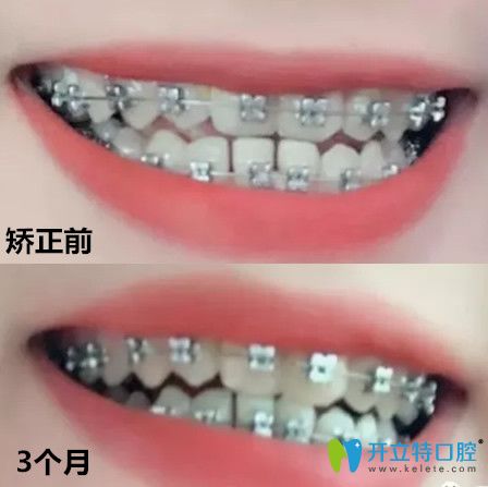 拜博口腔地包天矯正前后牙齒變化對(duì)比圖
