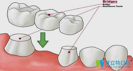 固定義齒能用一輩子嗎?優(yōu)缺點有哪些？南京美奧醫(yī)生解答