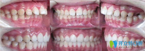 武漢健齒口腔牙齒矯正效果