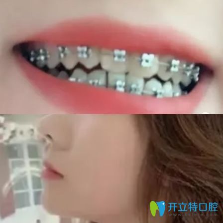 在杭州拜博口腔做地包天矯正3個(gè)月牙齒圖片