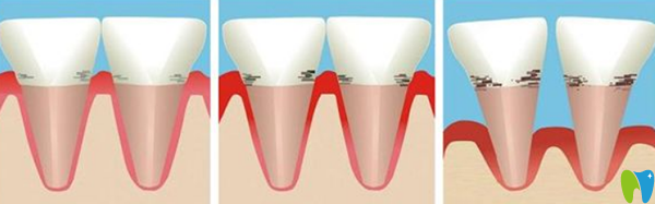 牙周病引起牙齒松動(dòng)的治療辦法