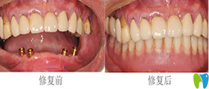 鄭州精益口腔種植牙前后效果對(duì)比圖