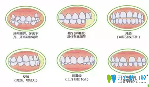 深度揭秘：在做牙齒矯正之前，你不得不了解的17個(gè)問題
