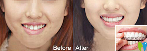 鄭州精益口腔李曉瑞牙齒矯正前后效果對(duì)比圖