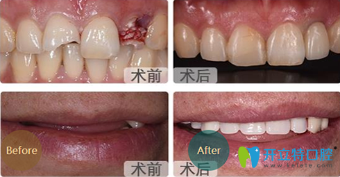 成都亞非口腔種植牙前后效果對比圖