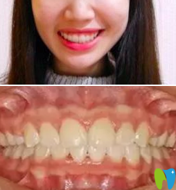 我在鄭州精益口腔做隱形牙齒矯正一年的效果