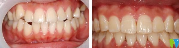 瑞爾口腔牙齒矯正前后效果圖